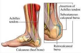 Achilles Tendon Pain and Leg Pain Relief