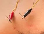 Electrical Acupuncture and Pain Management