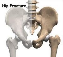 Hip Fractures and Hip Pain Relief